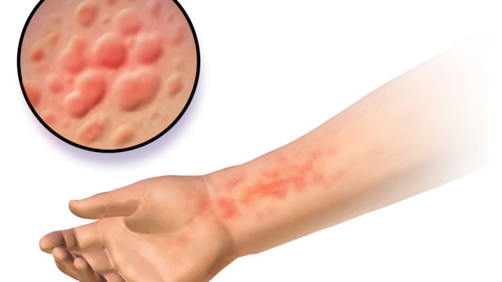 Urticaria por estrés Síntomas y tratamiento