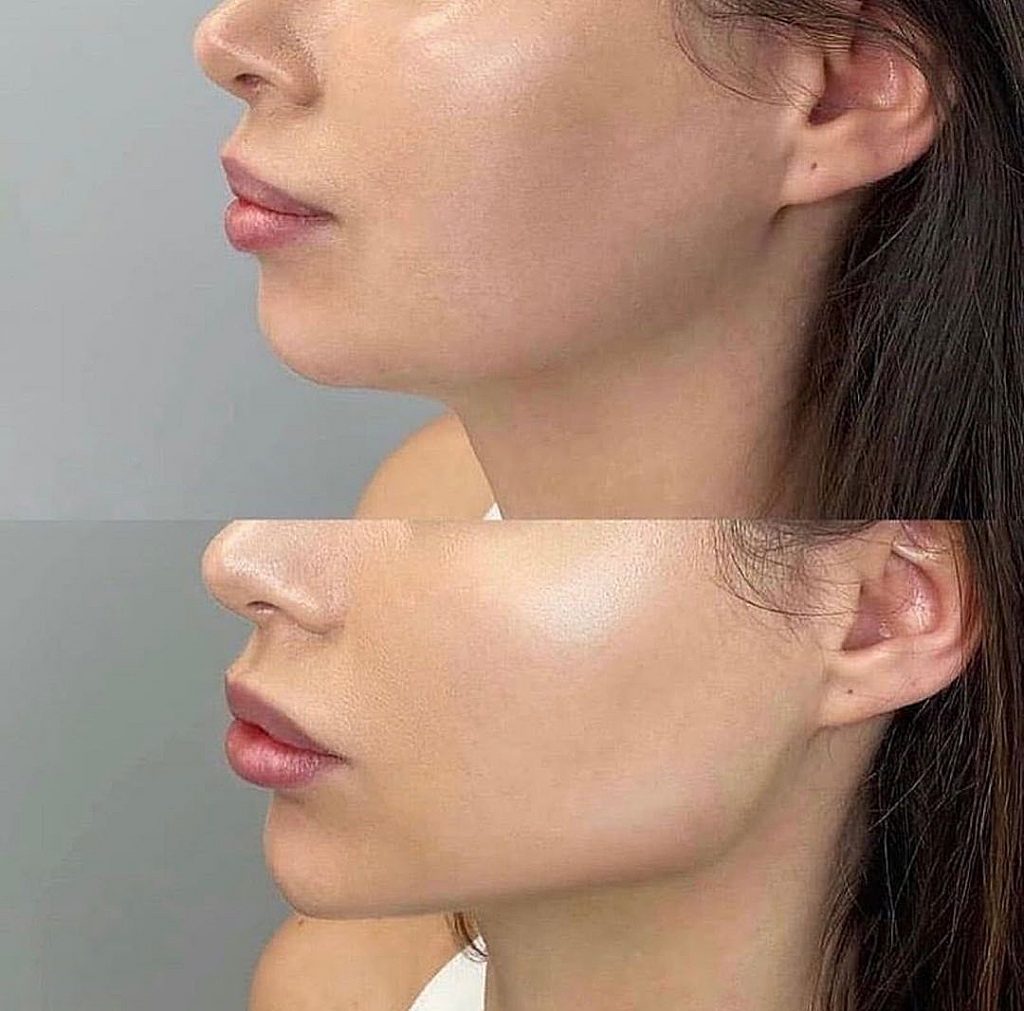 Antes. y después del russian contouring en AC DermaStudio