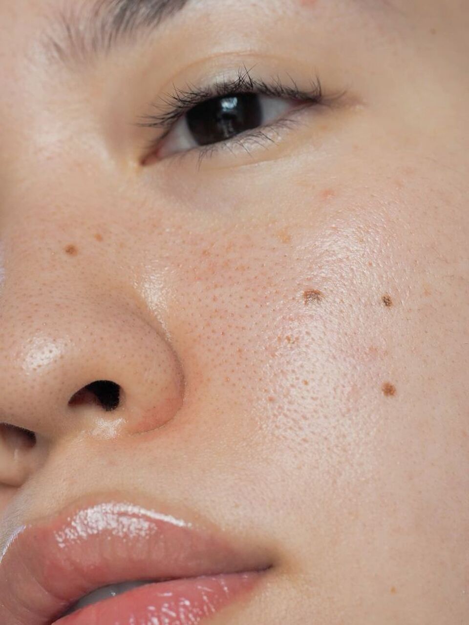 acne marcas tratamientos