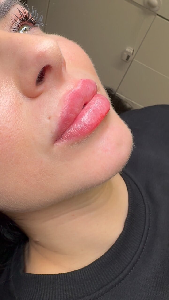 aumento de labios operacion