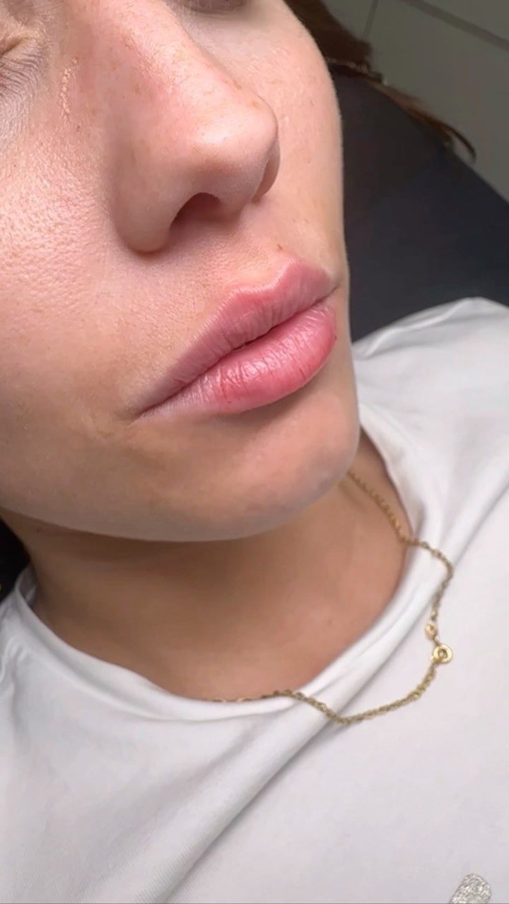 aumento de labios