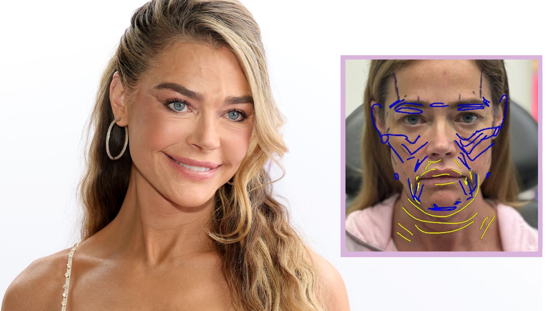 El ‘lifting’ de Denise Richards analizado por médicos: No sólo se ha eliminado exceso de piel