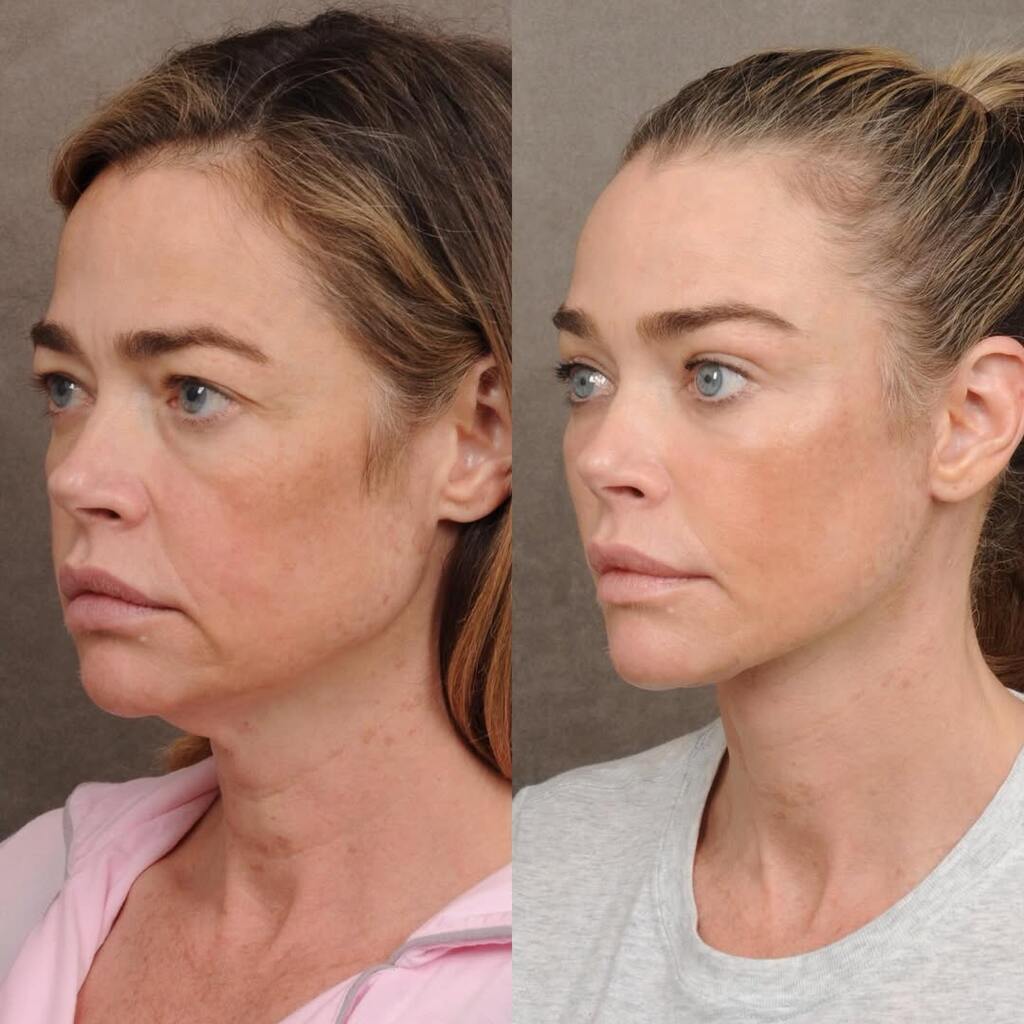 «No sólo se ha eliminado exceso de piel», el ‘lifting’ de Denise Richards analizado por médicos