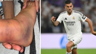 Así quedó el tobillo de Ceballos tras su lesión ante el Betis. (Redes sociales y Getty)