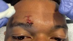 La marca en la ceja de Mbappé.