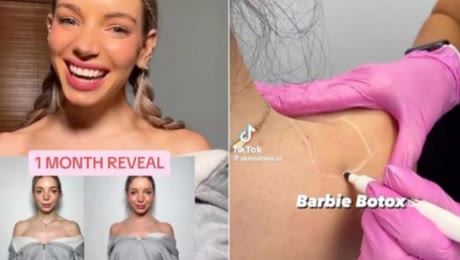 La &lsquo;Barbie B&oacute;tox&rsquo;, la &uacute;ltima locura de belleza que arrasa en redes sociales y que preocupa a los m&eacute;dicos
