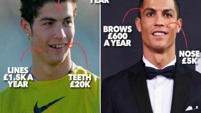 Cristiano Ronaldo, antes y después de la cirugía estética