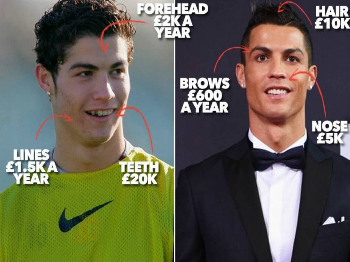 Cristiano Ronaldo, antes y después de la cirugía estética