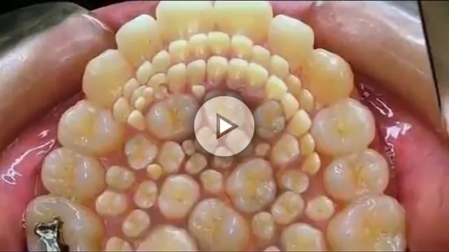 Extraen 232 dientes a un joven en la India