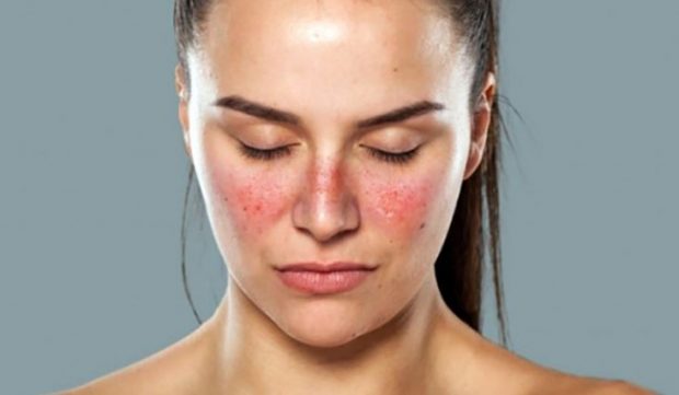 Enfermedad lupus