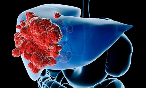 Las partículas contaminantes  presentes en el aire pueden producir cáncer de pulmón.