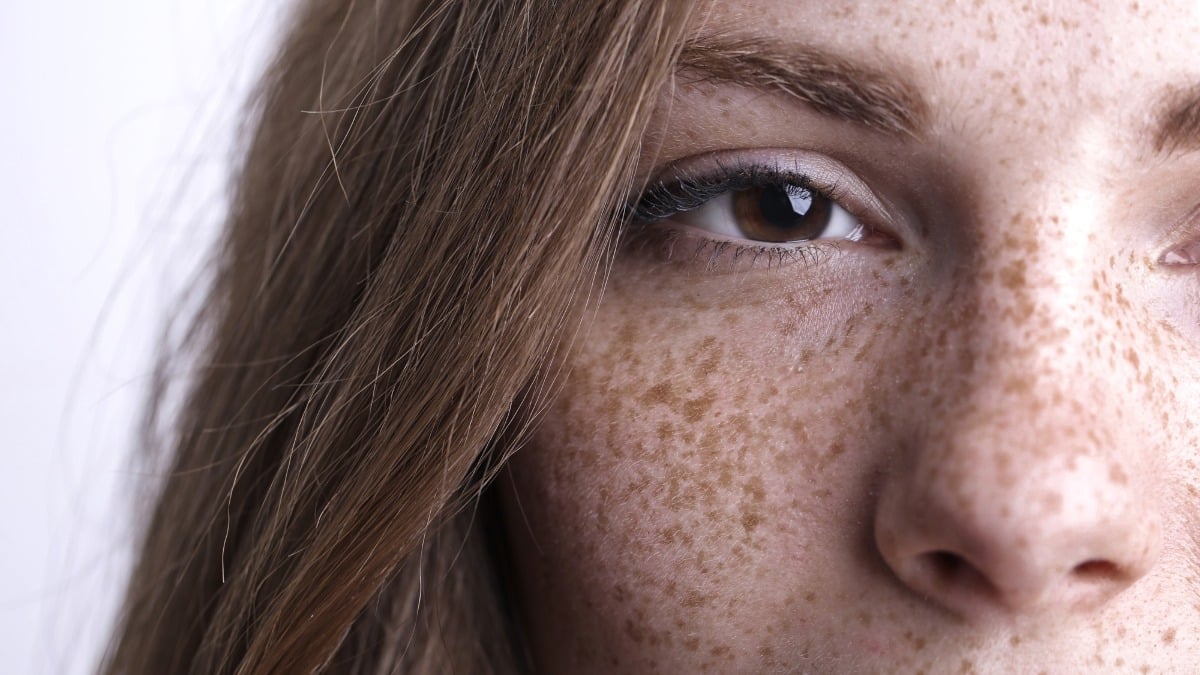 ¿Cómo se producen las pecas?