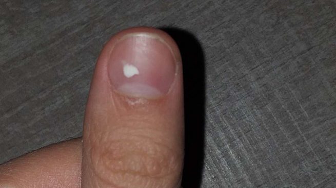 ¿Qué son las manchas blancas en las uñas?