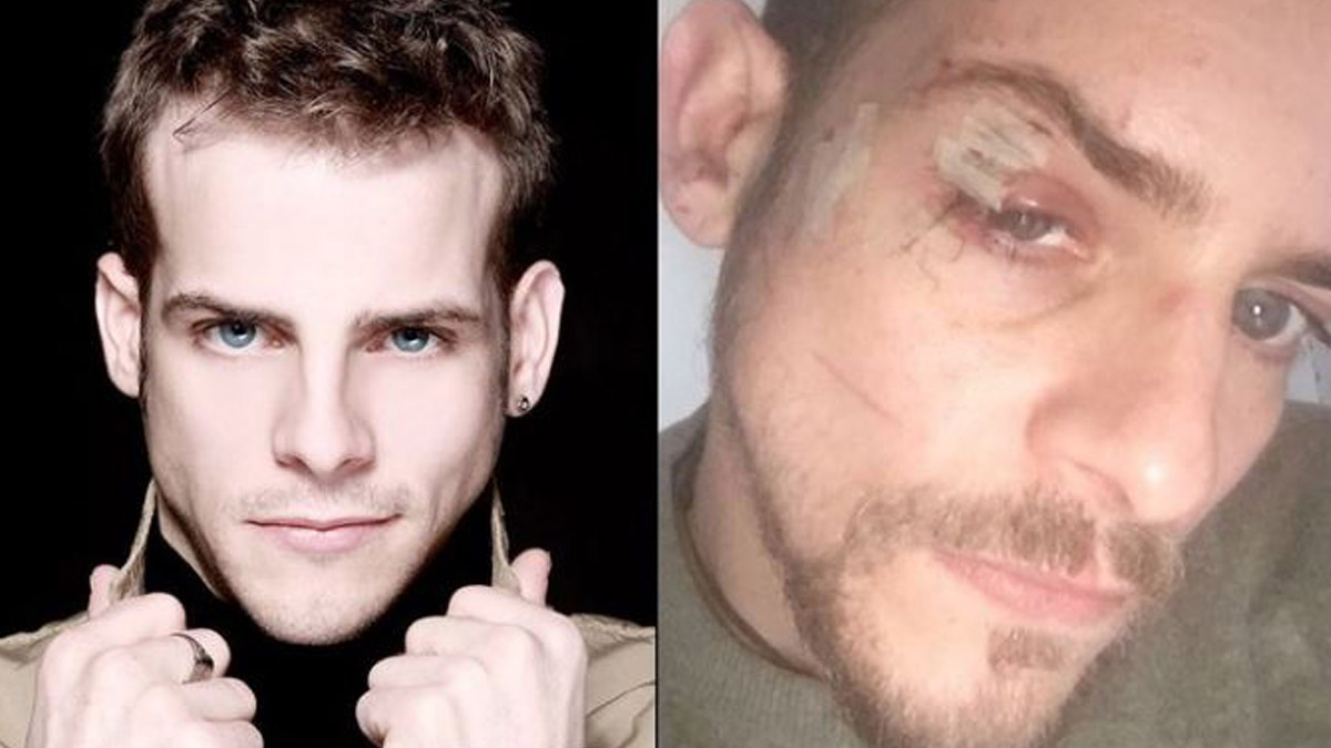 Así quedó la cara del cantante Àlex tras la agresión sufrida en Vigo.