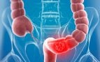 cáncer de colon