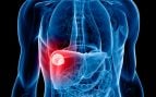 Cáncer de hígado