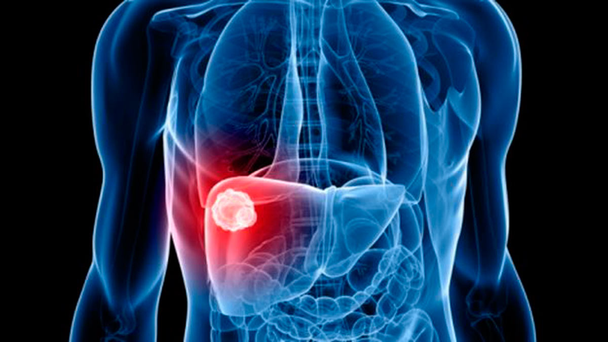 El cáncer de hígado es un tumor con mal pronóstico.