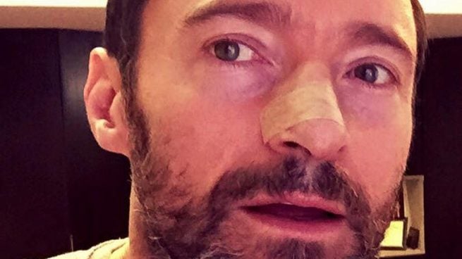 Hugh Jackman operado por quinta vez a causa de un cáncer de piel