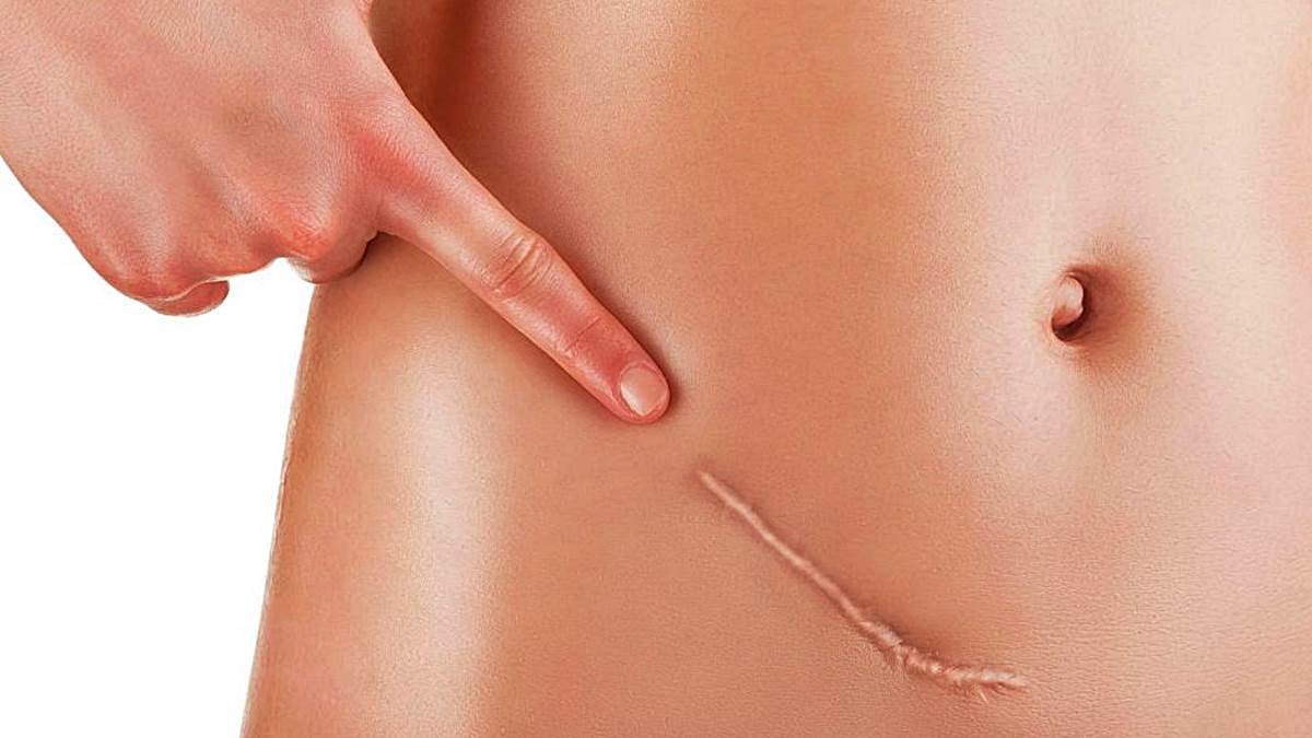 apendicitis donde esta el apendice apendicitis donde esta el apendice