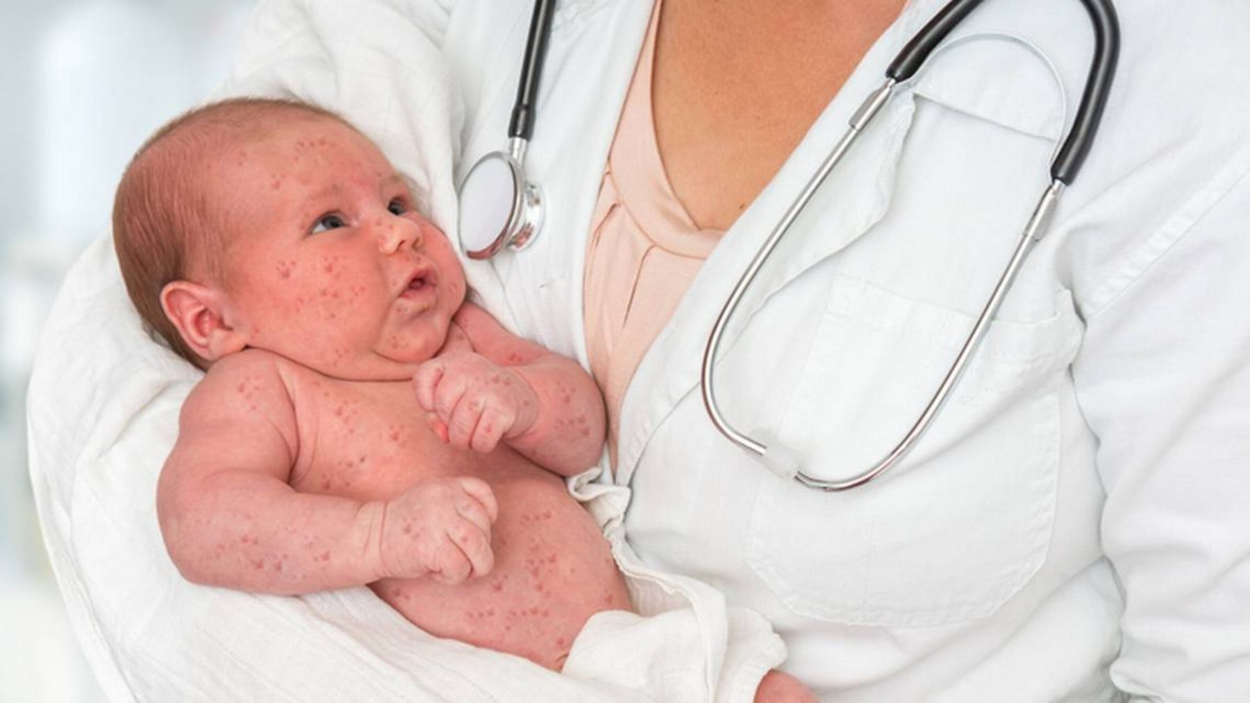 Qué es y cómo tratar el herpes neonatal en el bebé