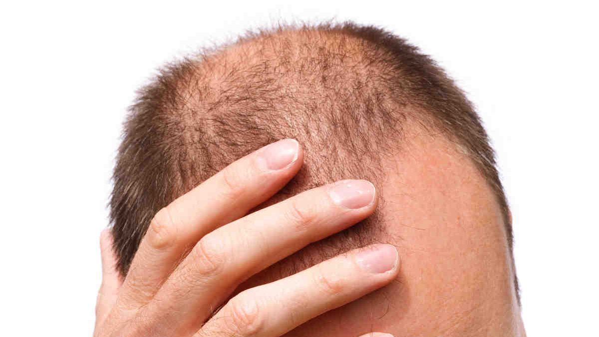 El trasplante de cabello pone solución a los casos de calvicie de origen hereditario.