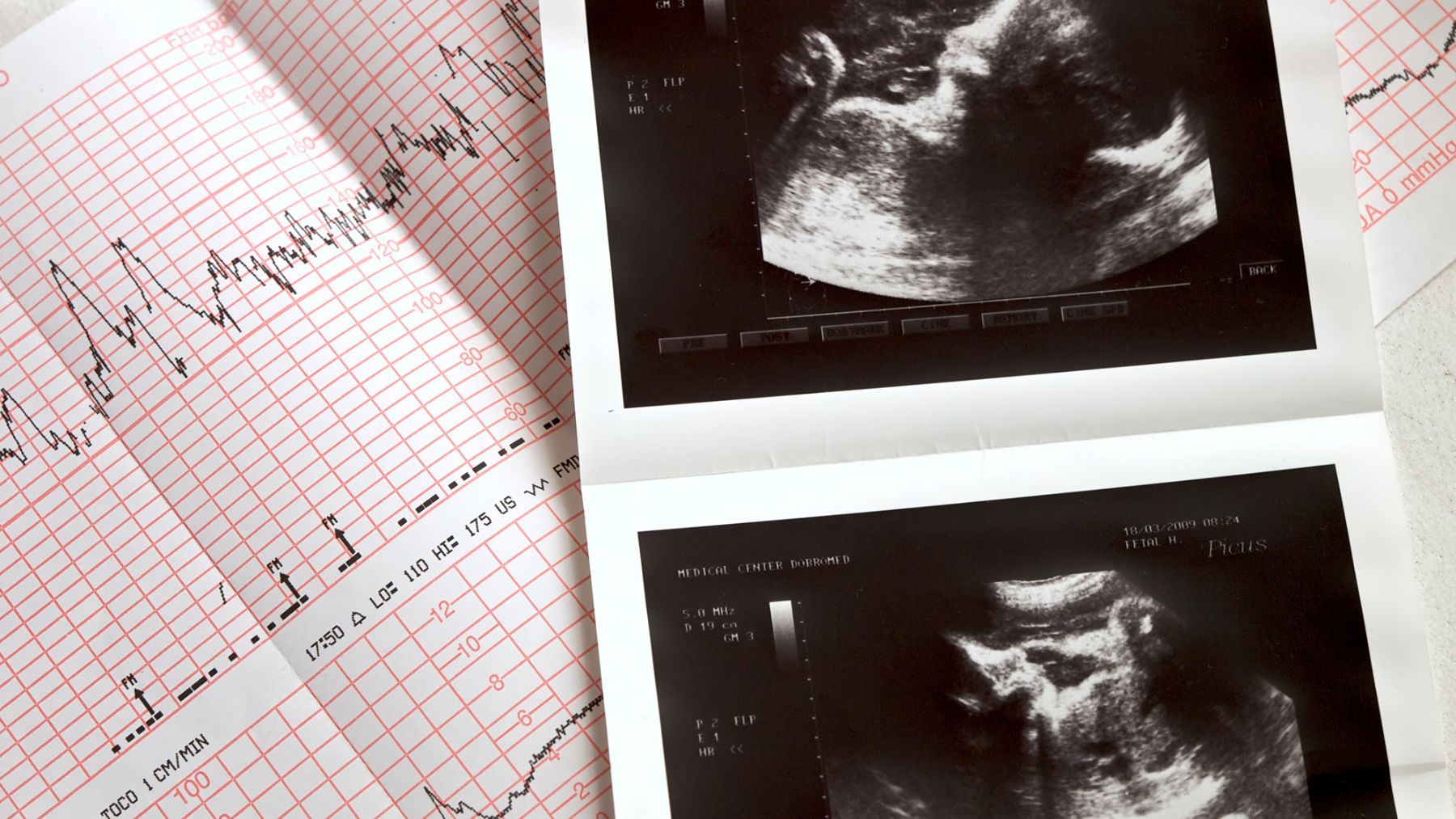 Qué es y cómo tratar el crecimiento intrauterino retardado