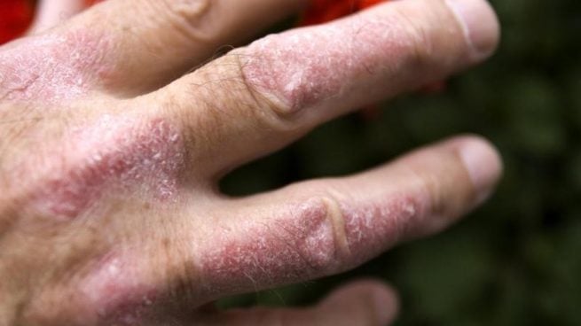 Psoriasis