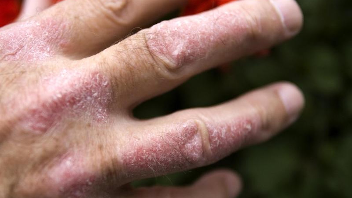 La psoriasis es una enfermedad de la piel no contagiosa.