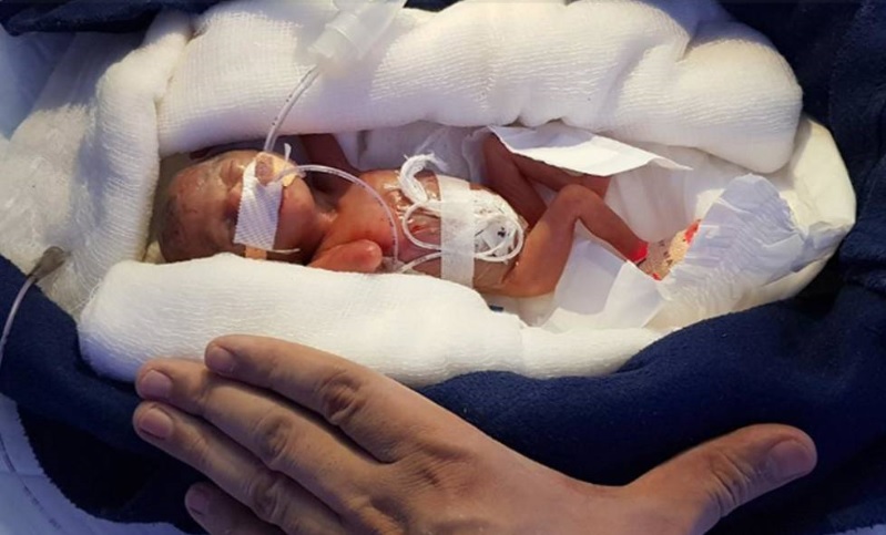 La bebé gran prematura que es un milagro por haber sobrevivido tras nacer con 400 gramos