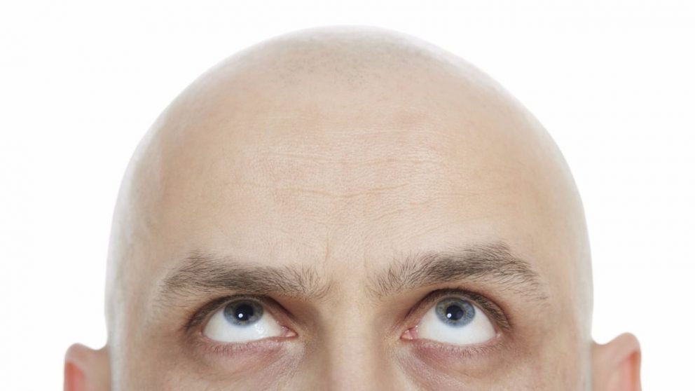 No todos los hombres se sienten cómodos con la caída del cabello.