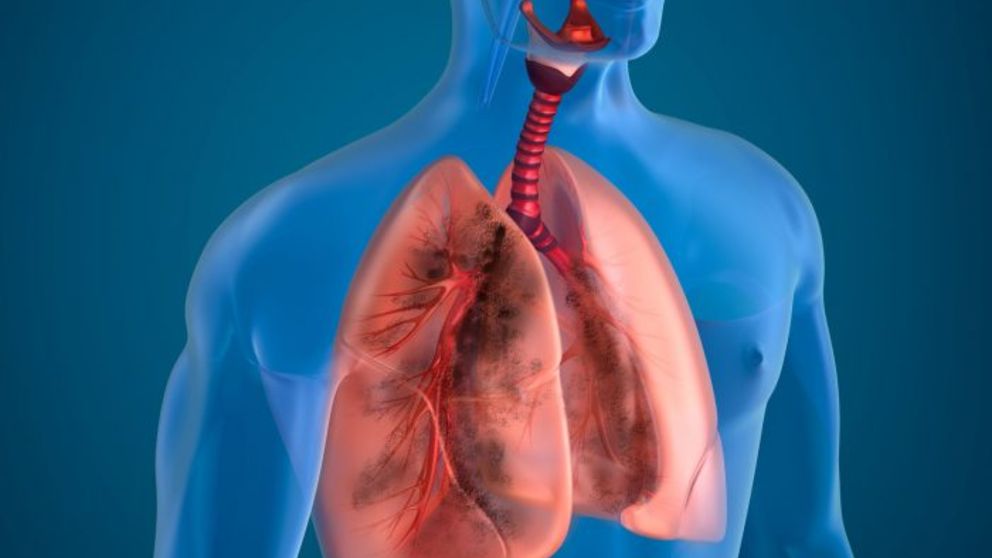 Un tratamiento aprobado para la tuberculosis resistente sucumbe a las ‘superbacterias’.