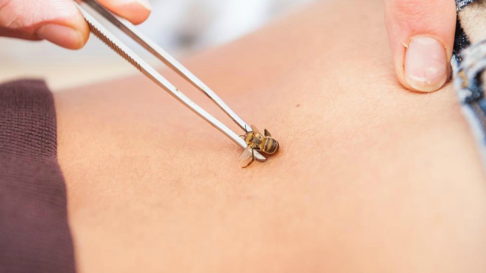La apiterapia es el uso terapéutico del veneno de abeja.