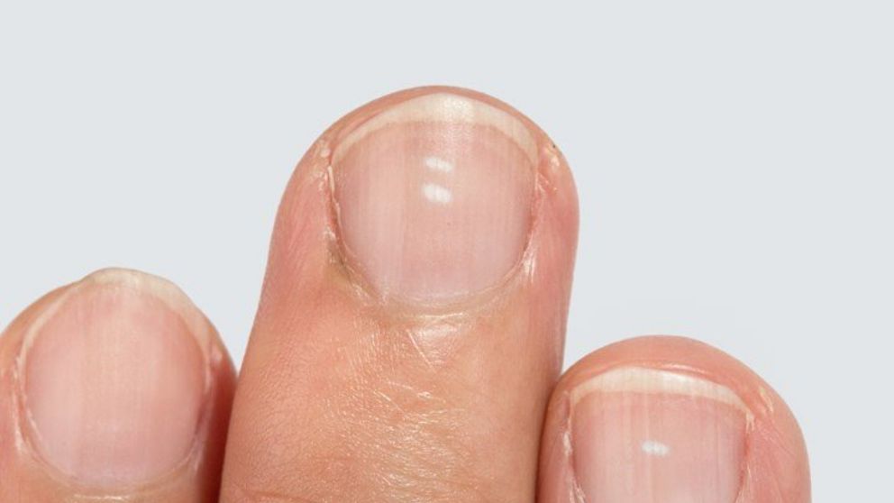 Contorno Por favor mira Isla Stewart Cómo quitar las manchas blancas de las uñas con remedios naturales