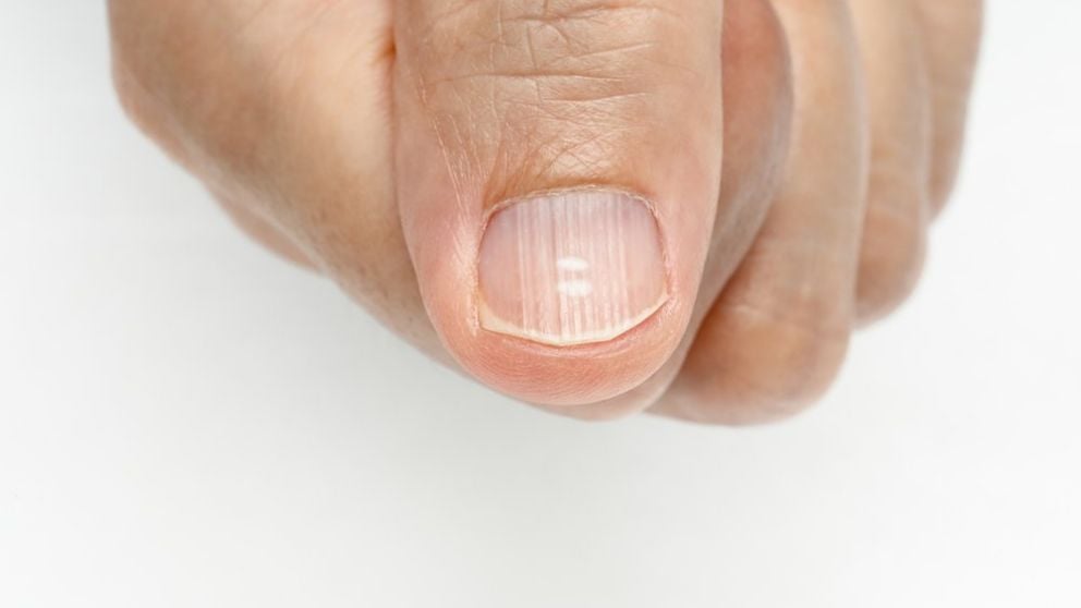 Por qué aparecen estrías en las uñas  betalfatrus