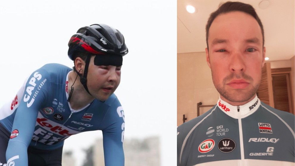 Sander Armée, con el rostro desfigurado en el Giro de Italia. (Twitter)