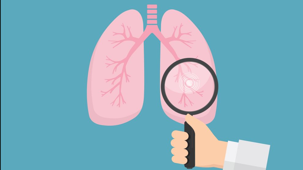 Cáncer de pulmón (Foto. Istock)