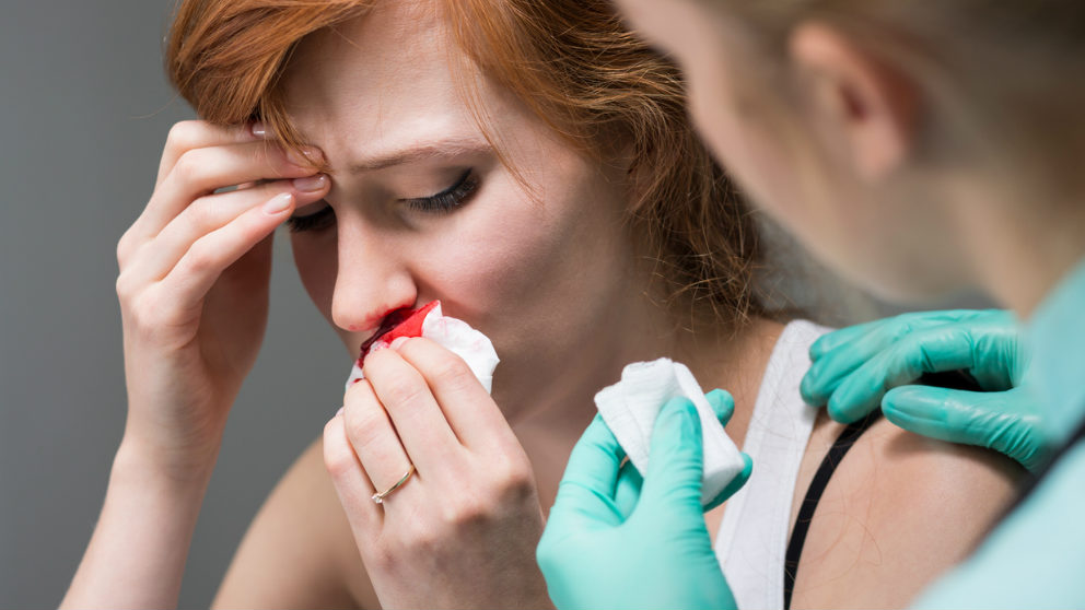 ¿Por qué nos sangra la nariz?