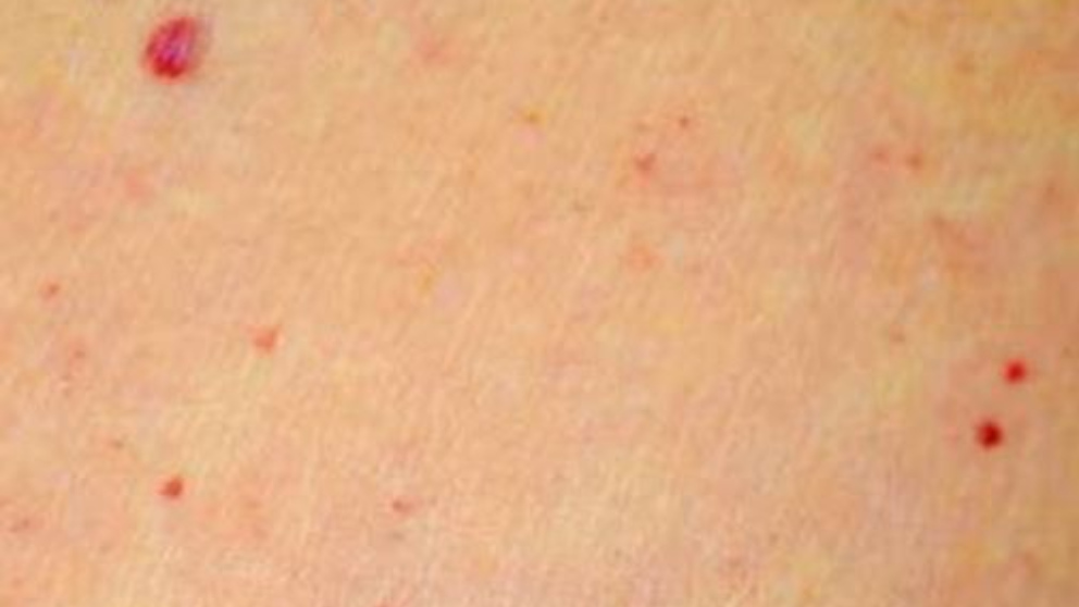 Burbuja de sangre en la pierna