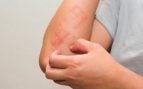 Psoriasis fertilidad