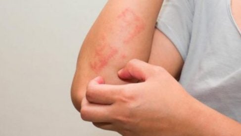 Una persona con signos de Psoriasis.
