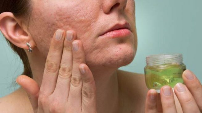 Anticuado basura Surichinmoi Cómo eliminar las cicatrices por acné con diferentes trucos