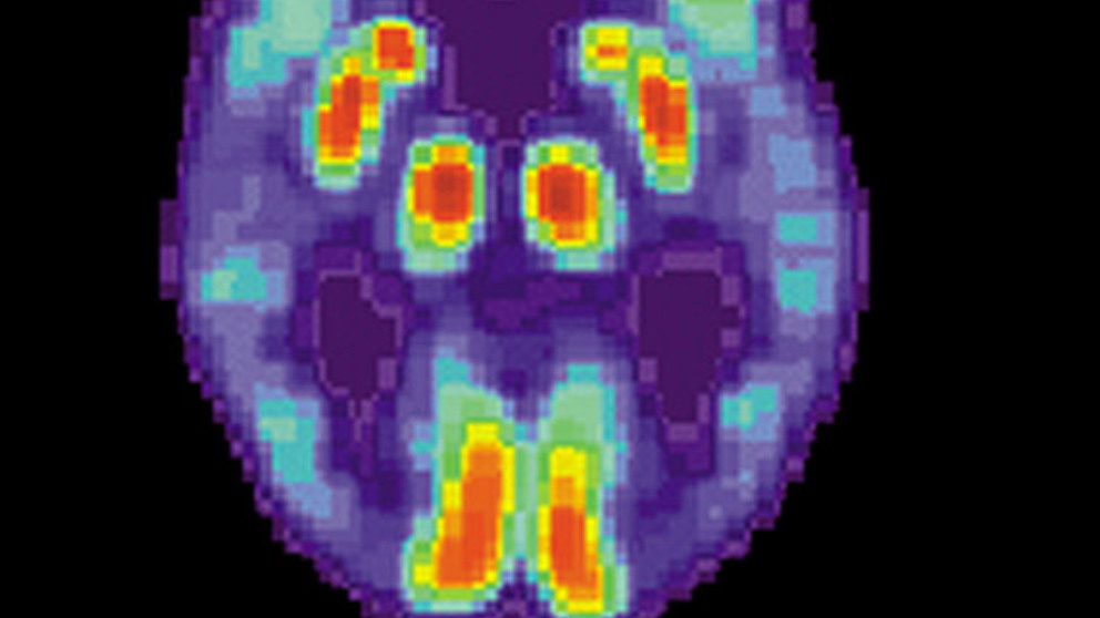 Una inteligencia artificial predice el Alzheimer