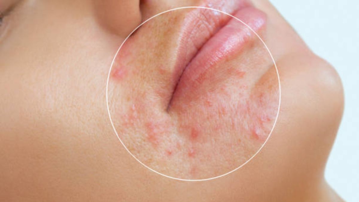 Repasamos algunos de los mitos y verdades en torno al acné