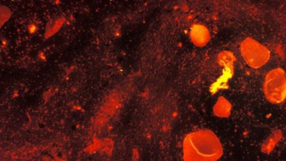 El diagnóstico de la tuberculosis puede ser algo complejo.