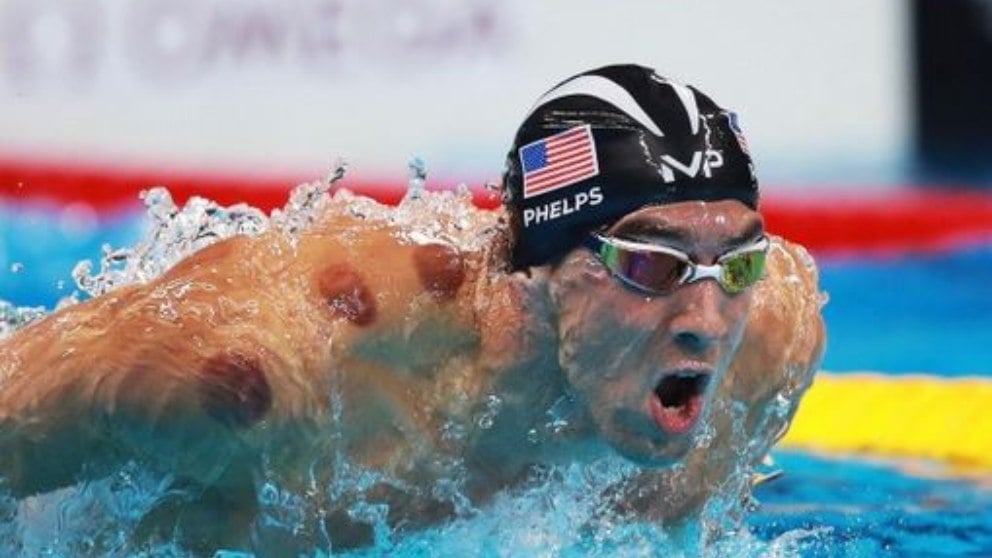 cupping