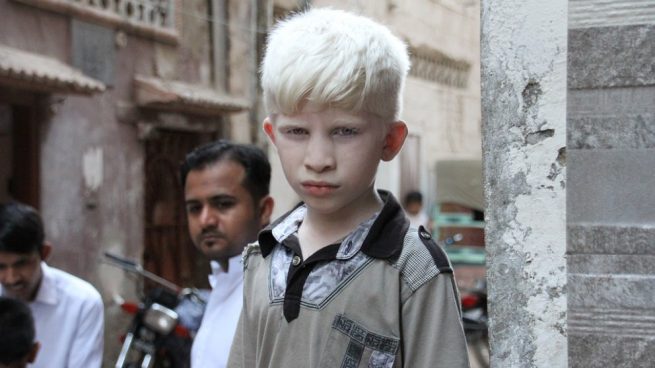 personas albinas