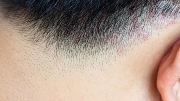 Encommium Salto Uluru Cómo curar la tiña del cuero cabelludo con remedios naturales