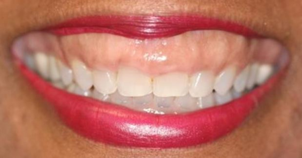 Qué son las fundas dentales y qué tipos hay