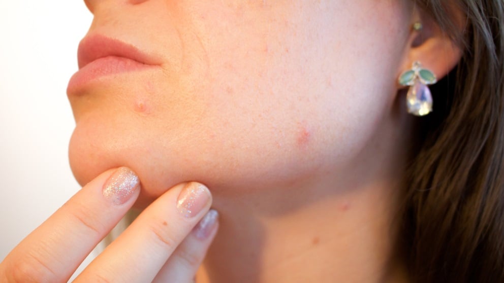 El acné resulta muy molesto a cualquier edad