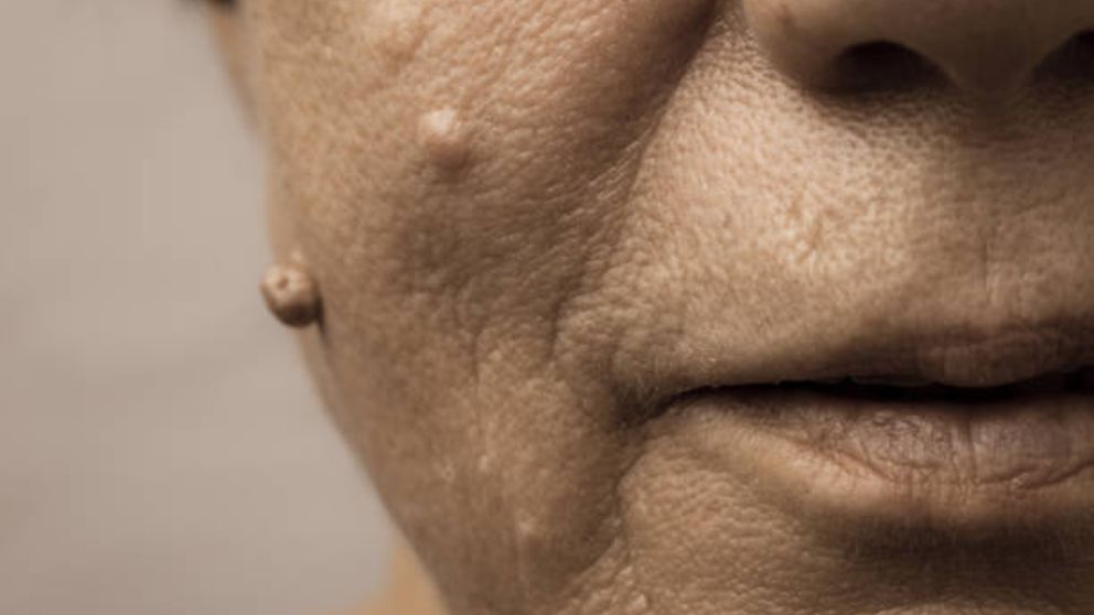 Aprende cómo quitar las verrugas de la cara con remedios naturales